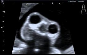Image result for What Is Anencephaly Baby
