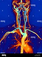 Image result for Internal Carotid and Vertebral Arteries