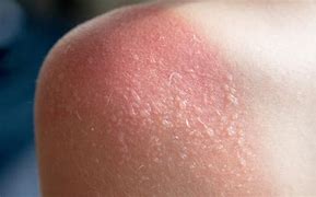 Image result for Sunburn On Legs