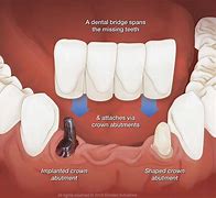 Image result for Parts of Dental Bridge