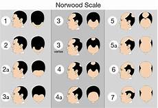 Norwood Scale Hair Loss Chart For Men With Pattern
