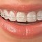 Image result for Propulseur Orthodontique