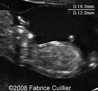 Image result for Acrania Ultrasound