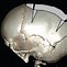Image result for Occipital Craniosynostosis
