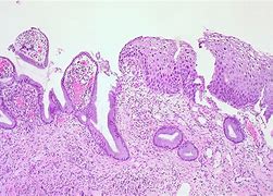 Image result for 2 Cm Dilated Cervix