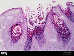 Image result for Molluscum Contagiosum Virus