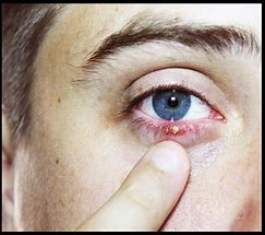 Image result for Skin Problems On Eyelids