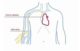Image result for PICC Line Tipp