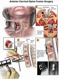 Image result for C5 C6 Disc Replacement Surgery