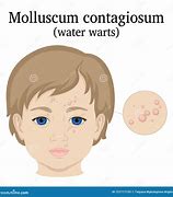 Image result for Molluscum Contagiosum Elbow