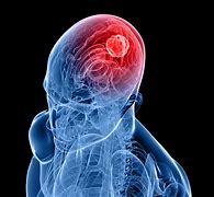 Image result for Benign Brain Tumor