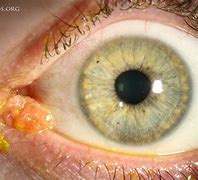 Image result for Papilloma Eye