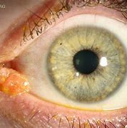 Image result for Conjunctival Papilloma Eyelid Histology