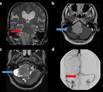 Image result for Papilloma Brain Tumor