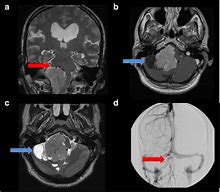 Image result for Choroid Plexus CT Scan