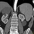 Image result for CT Scan Right Adnexal Cyst