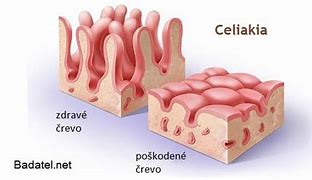 Image result for celiakia