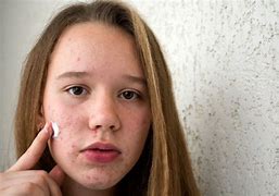 Image result for Teenager with Pimples Picture