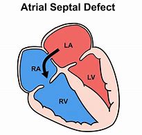 Image result for Atrial Septal Defect