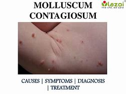 Image result for Molluscum Contagiosum Cluster