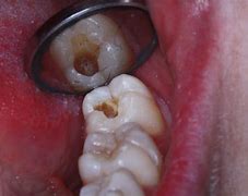 Image result for Cavity Severity Chart