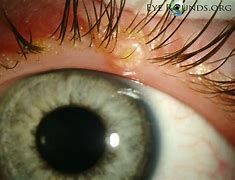 Image result for Moluscum Eye Lids