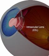 Image result for Artificial Eye Lens