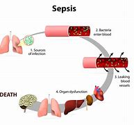 Image result for Sepsis Cure
