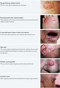 Image result for Squamous Cell Carcinoma Skin Cancer Treatment