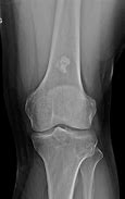 Image result for Distal Femur Chondroma