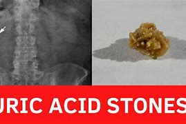 Image result for Pics of a 7Mm Uric Kidney Stone