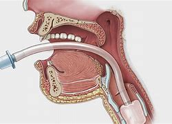 Image result for intubation