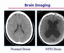 Image result for Hydrocephalus Imaging