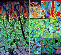 Image result for Basal Cell Carcinoma Under Microscope