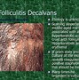 Image result for Folliculitis