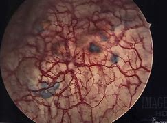 Image result for Chocolate Cyst with Adhesion