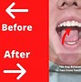 Image result for Byte Invisible Aligners Reviews