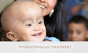 Image result for Hydrocephalus Surgery