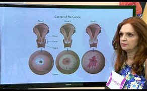 Image result for ca�utero