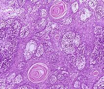 Image result for Microscopic Biopsies Image Squamous Cell Carcinoma Cervical Cancer