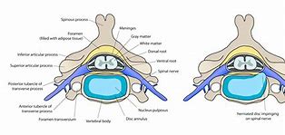 Image result for Lumbar Spine Disc Herniation