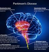 Image result for Parkinson's Disease