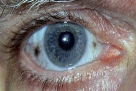 Image result for alcaptonuria