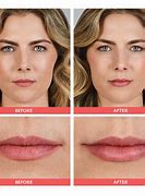 Image result for Different Lip Fillers