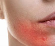 Image result for Allergic Skin Rash On Face