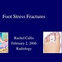 Image result for 2nd Metatarsal Stress Fracture