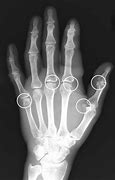 Image result for Accessory Sesamoid Bone Hand