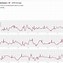 Image result for Lbbb Apple Watch ECG