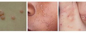 Image result for Musculosum Contagiosum