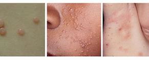 Image result for Molluscum Bumps On Skin